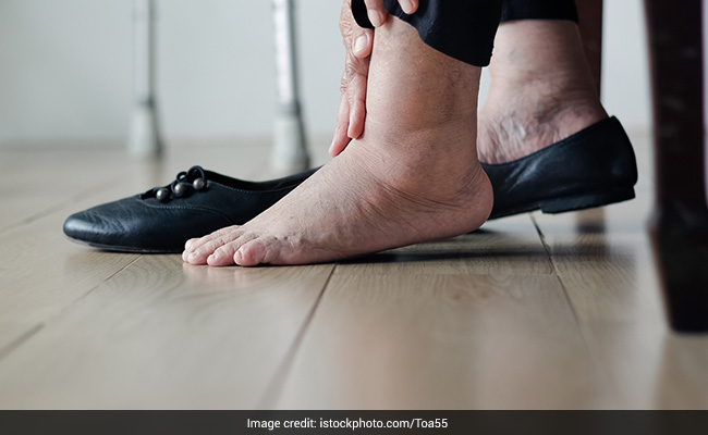 Home Remedies: पैरों की सूजन को खत्म करते हैं ये 3 जबरदस्त घरेलू उपाय, आसान होने के साथ-साथ असरदार भी हैं
