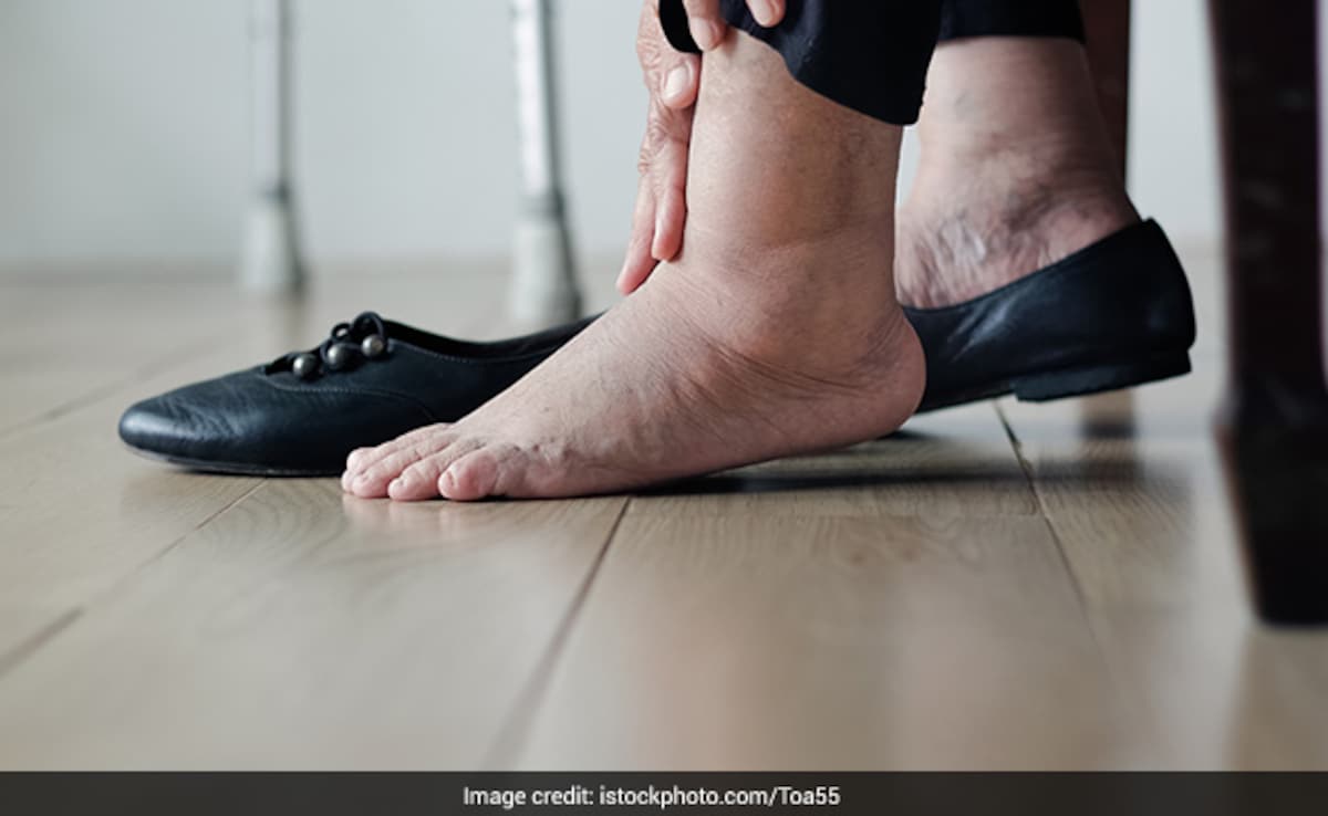 Swelling In These Body Parts Can Be A Sign Of Kidney Disease