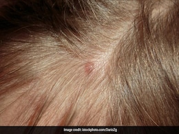 Hair Care: स्कैल्प में होने वाले पिंपल्स ने कर दिया है सिर का हाल बुरा तो अपनाएं ये नुस्खे, बाल झड़ने भी हो जाएंगे बंद Hair Care: स्कैल्प में होने वाले पिंपल्स ने कर दिया है सिर का हाल बुरा तो अपनाएं ये नुस्खे, बाल झड़ने भी हो जाएंगे बंद