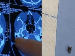 खोपड़ी में 20 साल से फंसी थी गोली, सिर दर्द का इलाज कराने पर मालूम हुआ खौफनाक सच खोपड़ी में 20 साल से फंसी थी गोली, सिर दर्द का इलाज कराने पर मालूम हुआ खौफनाक सच