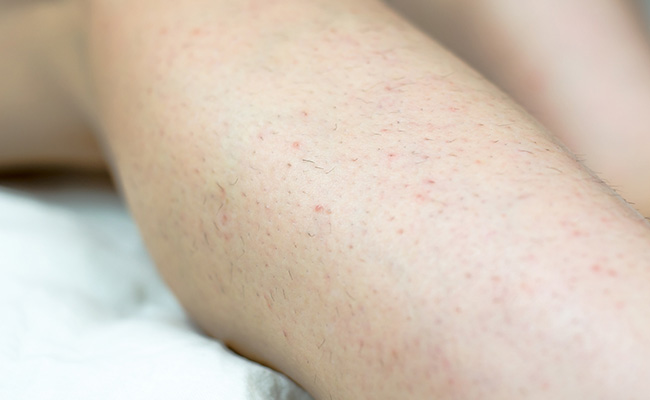 डॉक्टर गीतिका से जानिए त्वचा के अंदर दबे Ingrown Hair से किस तरह पाया जाता है छुटकारा, ये टिप्स भी आएंगे काम 