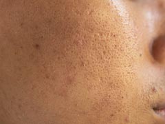 Skin Care Tips: त्वचा के खुले रोम यानि Open Pores से छुटकारा पाने के लिए 5 जबरदस्त घरेलू उपाय, चमक भी आएगी