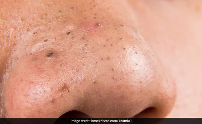 How To Get Rid Of Blackheads: आसानी से पा सकते हैं ब्लैकहेड्स से छुटकारा, बस घर पर इन कारगर घरेलू नुस्खों को आजमाएं