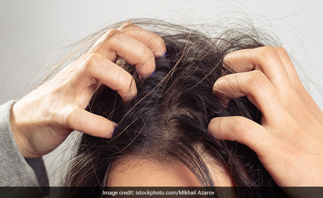 Hair Care Tips: Know The Signs And Symptoms Of An Unhealthy Scalp