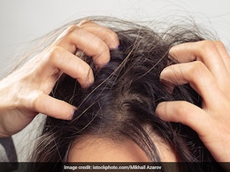 स्कैल्प पर फंगल इंफेक्शन से जम गया है डैंड्रफ तो यह तरीका आएगा काम, सिर की हो जाएगी अच्छी सफाई
