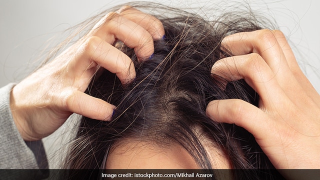 Haircare: Dry scalp cam cause dandruff and itchiness