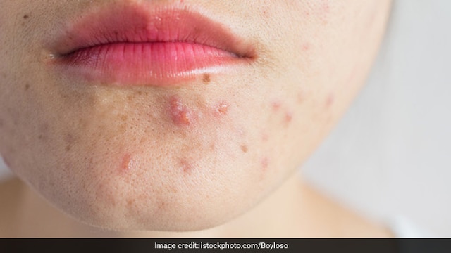 Acne causes: Stress can worsen acne