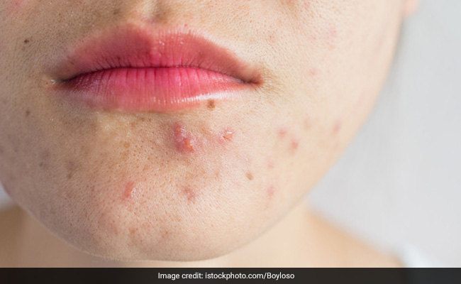 Acne causes: Stress can worsen acne