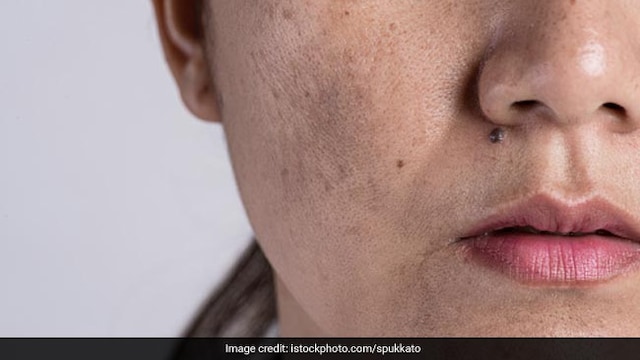 A deficiency of vitamin B2 (Riboflavin) can also lead to oily skin