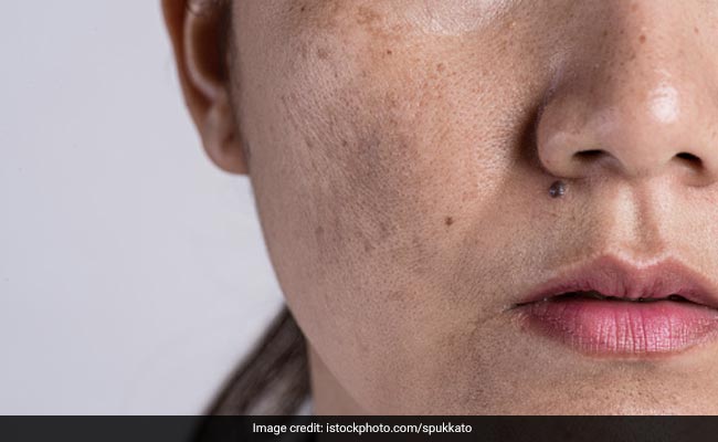 A deficiency of vitamin B2 (Riboflavin) can also lead to oily skin