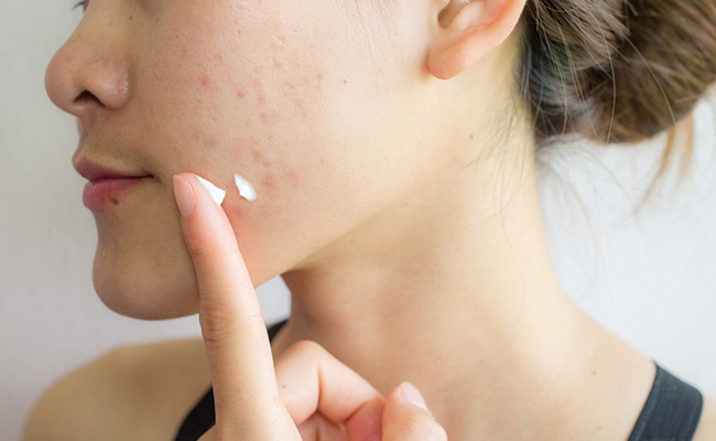 Bookmark These Amazing Spot Creams For Clear Skin