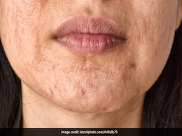 मुंह के आसपास की त्वचा पिग्मेंटेशन से हो जाती है काली, घर की ये 4 चीजें दिला सकती हैं इस दिक्कत से निजात मुंह के आसपास की त्वचा पिग्मेंटेशन से हो जाती है काली, घर की ये 4 चीजें दिला सकती हैं इस दिक्कत से निजात