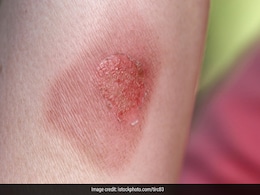Skin Burn: जलने पर फफोले पड़े उससे पहले ही अपना लें ये घरेलू उपाय, गहरे धब्बे पड़ने की गुंजाइश होगी कम Skin Burn: जलने पर फफोले पड़े उससे पहले ही अपना लें ये घरेलू उपाय, गहरे धब्बे पड़ने की गुंजाइश होगी कम