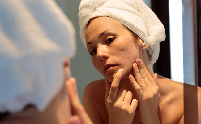 What Are Pockmarks And How To Tackle Them