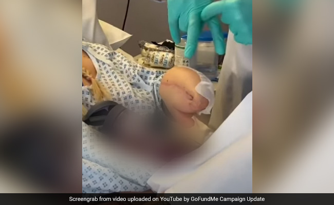 UK Woman Left With 'Shark Hand' After Battle With Sepsis