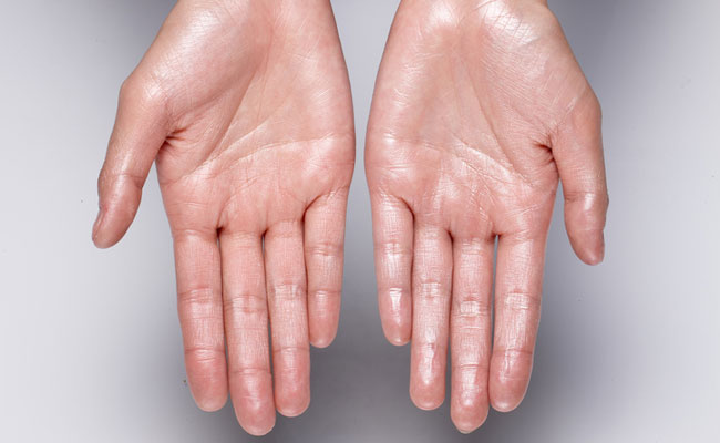 Your palms have a high concentration of sweat glands that respond quickly to emotional triggers.
