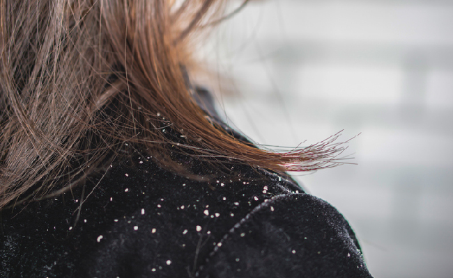 Bookmark These Tips Now To Remove Dandruff