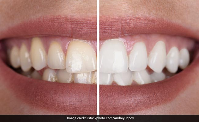 Teeth Whitening: मोती जैसे सफेद चमकने लगेंगे आपके भी दांत, बस इस्तेमाल करना होगा यह कमाल का पाउडर 