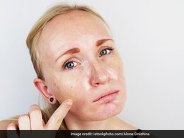 क्या चेहरे पर झाइयां, डार्क स्पॉट पड़ने के कारण जानते हैं आप? इन देसी उपचारों की मदद से पाएं साफ और दमकता चेहरा क्या चेहरे पर झाइयां, डार्क स्पॉट पड़ने के कारण जानते हैं आप? इन देसी उपचारों की मदद से पाएं साफ और दमकता चेहरा