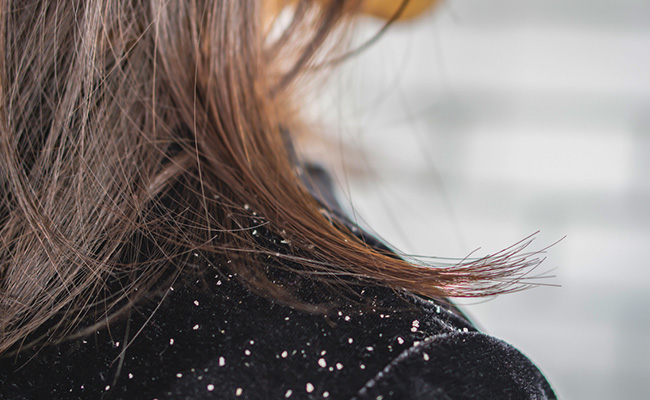 Dandruff Flakes: Here's How To Get Rid Of Dandruff Flakes