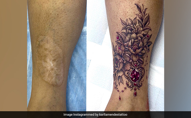 टैटू की मदद से पुराने दागों को ढकने और खूबसूरत शक्ल देने लगे हैं आर्टिस्ट, देश-विदेश में लोग आजमा रहे हैं ये ट्रेंड