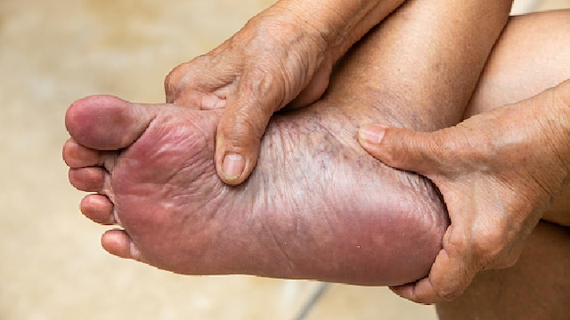 Massaging the affected joints with warm mustard oil can help reduce inflammation