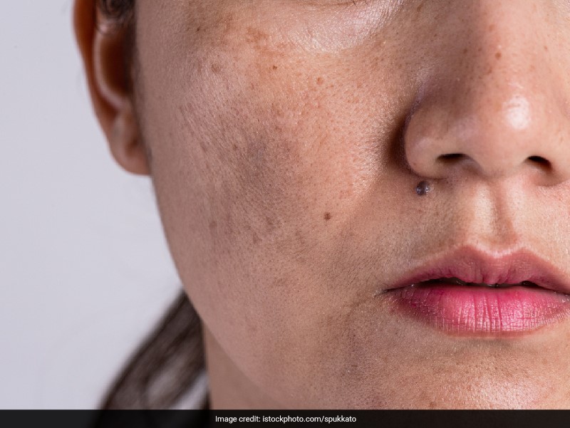 Skin Pigmentation: Easy Home Remedies To Tackle This Common Beauty Problem