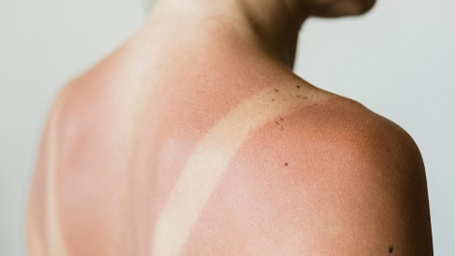 Sunburns cause the skin to become red and inflamed