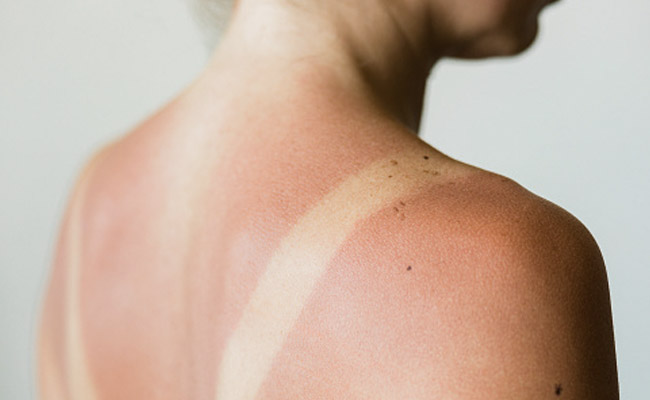Sunburns cause the skin to become red and inflamed