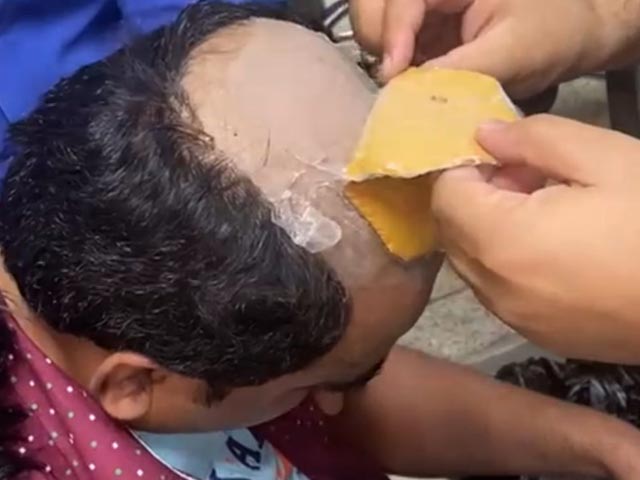 Busted For Smuggling Gold Worth Rs 26 Lakh In Wig, Rectum