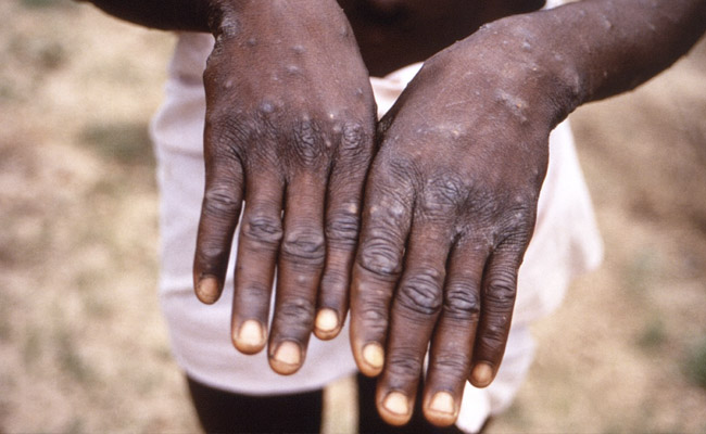 Monkeypox can cause rashes and spots on over the skin