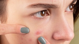 Should You Drink Milk If Your Skin Keeps Breaking Out - Expert Suggests
