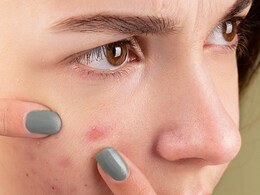 Should You Drink Milk If Your Skin Keeps Breaking Out - Expert Suggests