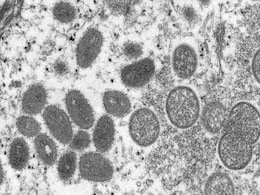 Scotland Detects Its First Monkeypox Case Scotland Detects Its First Monkeypox Case