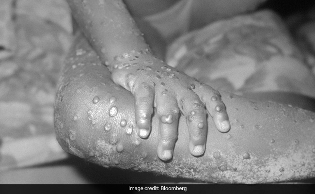 Monkeypox: How Can You Catch It And What Are The Symptoms?