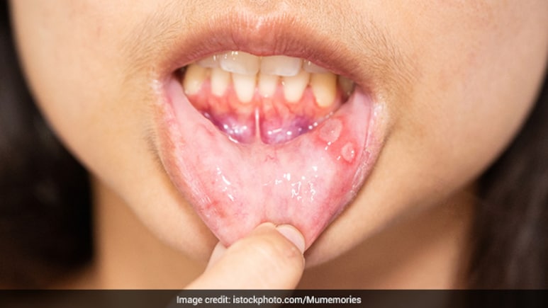 मुंह के छाले के उपाय: जानें मुंह के छाले कैसे ठीक करें, घरेलू उपाय | Munh ke Chhale ke Upay