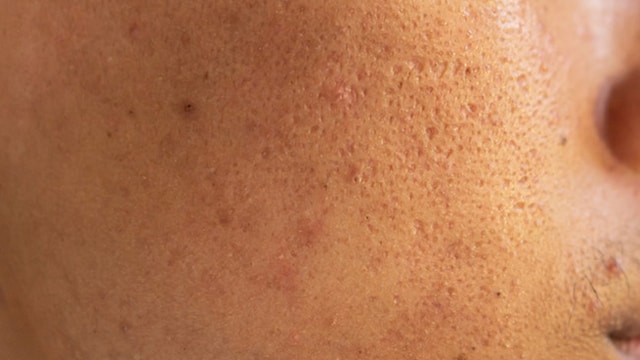 Skin pores are vital because they allow the skin to breathe and are good for hydration