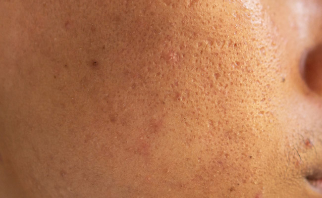 Skin pores are vital because they allow the skin to breathe and are good for hydration