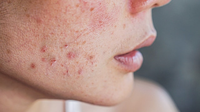 Acne: Bacterial deposits can cause clogging of skin pores