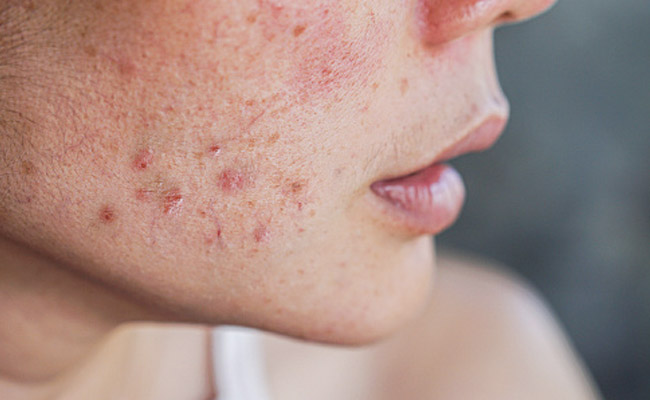 PCOS can cause severe acne which can be tough to manage