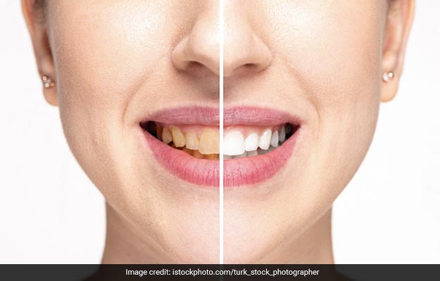 दांतों के पीलेपन से छुटकारा पाने के लिए Teeth Whitening कराने के भी हैं कई नुकसान, जानें यहां