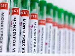 Suspected Case Of Monkeypox Found In Telangana Suspected Case Of Monkeypox Found In Telangana