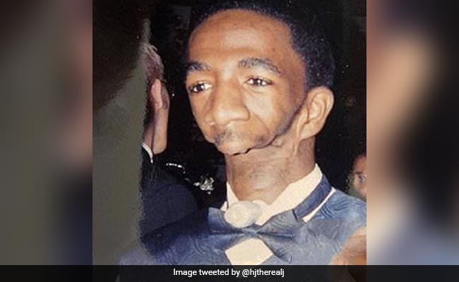 Otofacial Syndrome Left Chicago's Joseph Williams Without Jaw, He Refused To Give Up