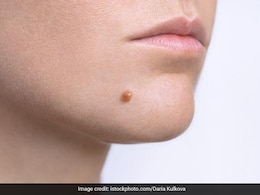 तिल और मस्से रातों रात होंगे गायब, बस इस तेल के साथ लगा लें ये एक चीज, लोग देखकर रह जाएंगे दंग