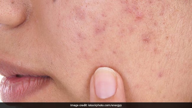 Do oily foods actually cause acne?