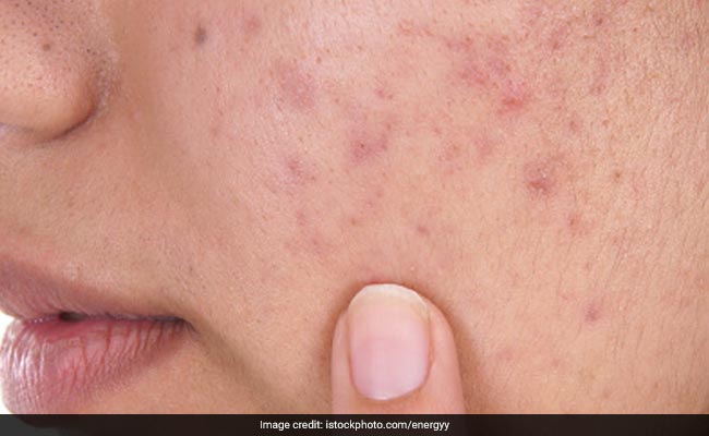 Do oily foods actually cause acne?