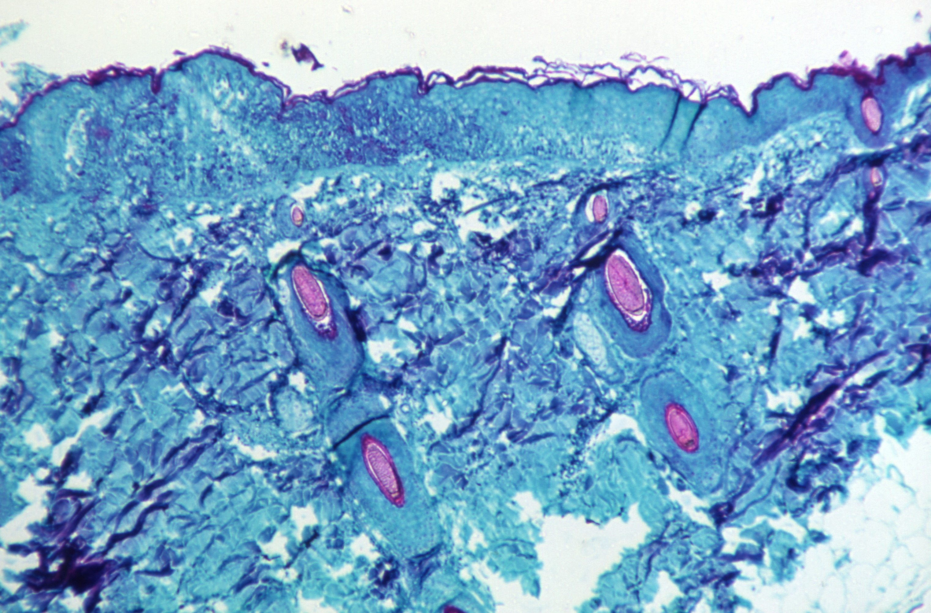 Switzerland Reports First Monkeypox Case As Virus Spreads