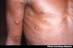 Monkeypox Cases Now In 14 Countries, Compulsory Quarantine In Belgium Monkeypox Cases Now In 14 Countries, Compulsory Quarantine In Belgium