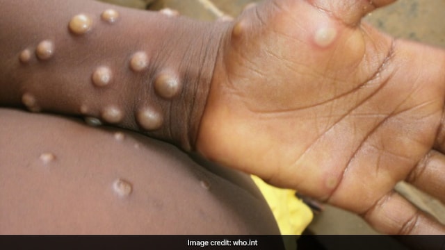 Lymph nodes formed in Monkeypox are swollen unlike Chickenpox