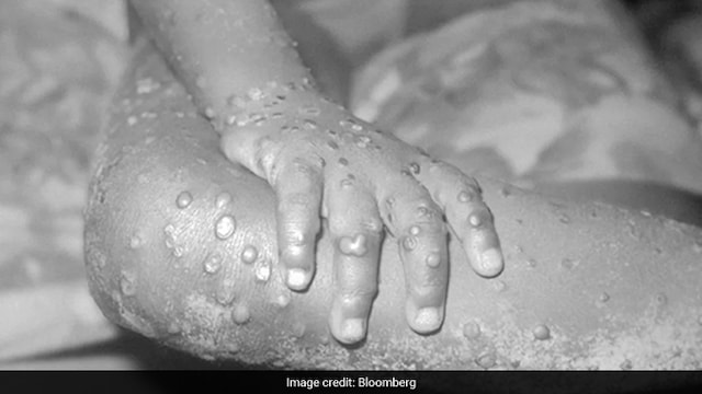 Monkeypox is similar to smallpox and causes swollen lymph nodes